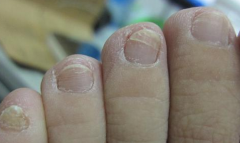 灰指甲用什么有效？知足抗菌足膜能根治